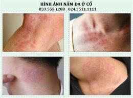 ảnh chụp màn hình bệnh da gà ở cổ