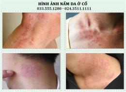 ảnh chụp màn hình cách chữa da gà ở cổ