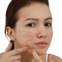 ảnh chụp màn hình da bị nổi mụn như da gà