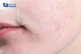 ảnh chụp màn hình da bị sần sùi như nổi da gà