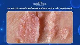 ảnh chụp màn hình đã có ai khỏi sùi mào gà chữa