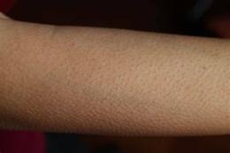 ảnh chụp màn hình da mặt bị nổi sần như da gà