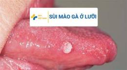 ảnh chụp màn hình đốt sùi mào gà ở bệnh viện da liễu webtretho
