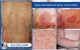 ảnh chụp màn hình mẩn ngứa nổi da gà