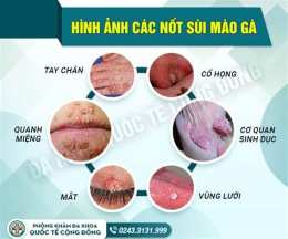ảnh chụp màn hình những người đã chữa khỏi sùi mào gà