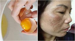 ảnh chụp màn hình trị nám da mặt bằng trứng gà