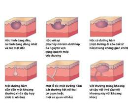 ảnh chụp màn hình vết thương da lành có ăn thịt gà được không