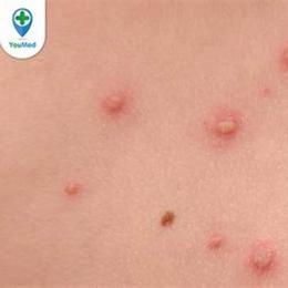 bị nổi hạt nhỏ như da gà