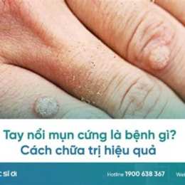 cách chữa da gà