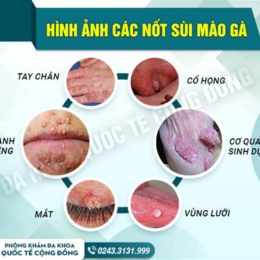 chữa bệnh sùi mào gà ở đà nẵng