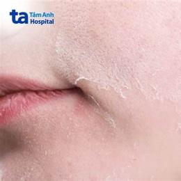 da bị sần sùi như da gà ngứa