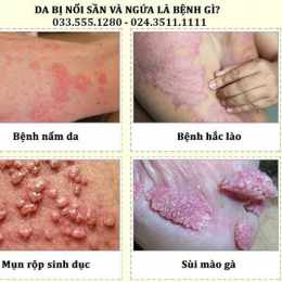 da chân bị sần sùi như da gà
