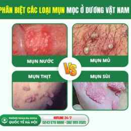 dương vật nổi mụn như da gà