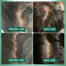 gàu da đầu vảy trắng