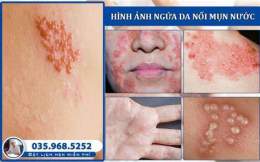 hướng dẫn sử dụng da bị nổi mụn như da gà