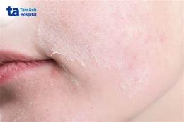 hướng dẫn sử dụng da bị sần sùi như da gà ngứa