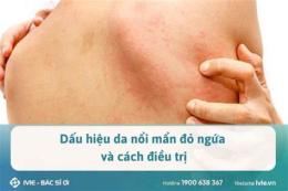 hướng dẫn sử dụng mẩn ngứa nổi da gà