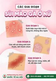 hướng dẫn sử dụng những người đã chữa khỏi sùi mào gà