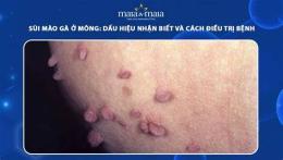 hướng dẫn sử dụng nổi da gà ở mông