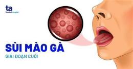 hướng dẫn sử dụng sùi mào gà là bệnh da liễu hay phụ khoa