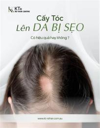 hướng dẫn sử dụng trứng chấy trên tóc gần da đầu