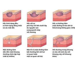 hướng dẫn sử dụng vết thương da lành có ăn thịt gà được không