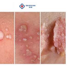 nguyên nhân dẫn đến sự đa dạng mào ở gà