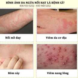 nổi da gà có nguy hiểm không