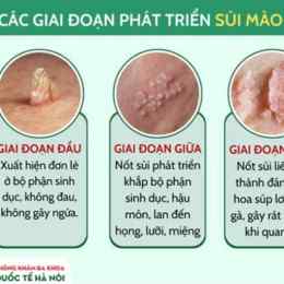 sùi mào gà có phải bệnh da liễu