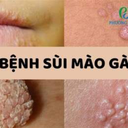 sùi mào gà là bệnh da liễu hay phụ khoa