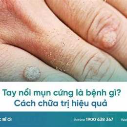 tay bị nổi da gà