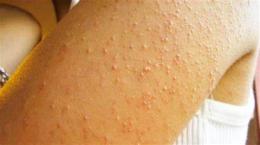 tính năng nổi bật bị da gà phải làm sao