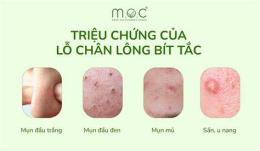 tính năng nổi bật lỗ chân lông nổi như da gà