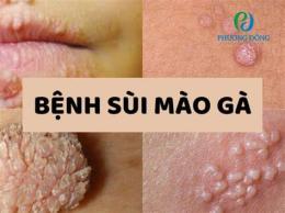 tính năng nổi bật sùi mào gà có phải bệnh da liễu