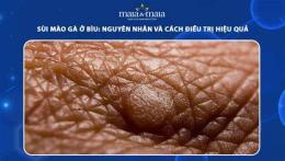 tính năng nổi bật sùi mào gà da bìu