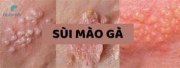 tính năng nổi bật tôi đã khỏi sùi mào gà