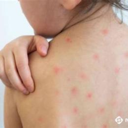 trẻ em sốt nổi da gà