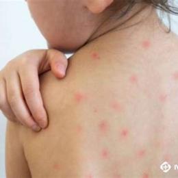 trẻ sốt mà nổi da gà