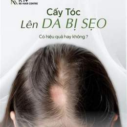 trứng chấy trên tóc gần da đầu