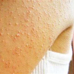 tự nhiên hay bị nổi da gà